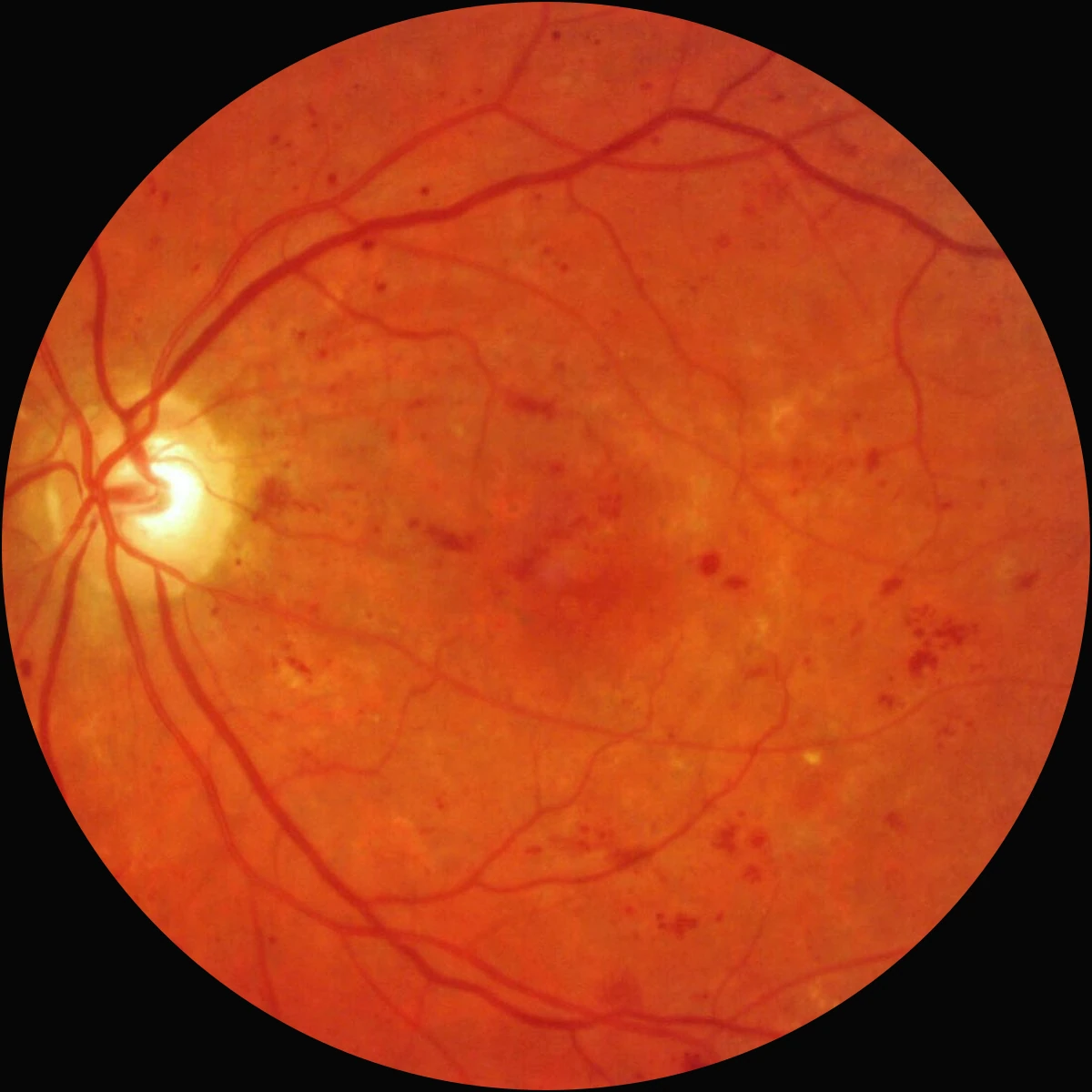 Fundus photograph: Diabetic retinopathy