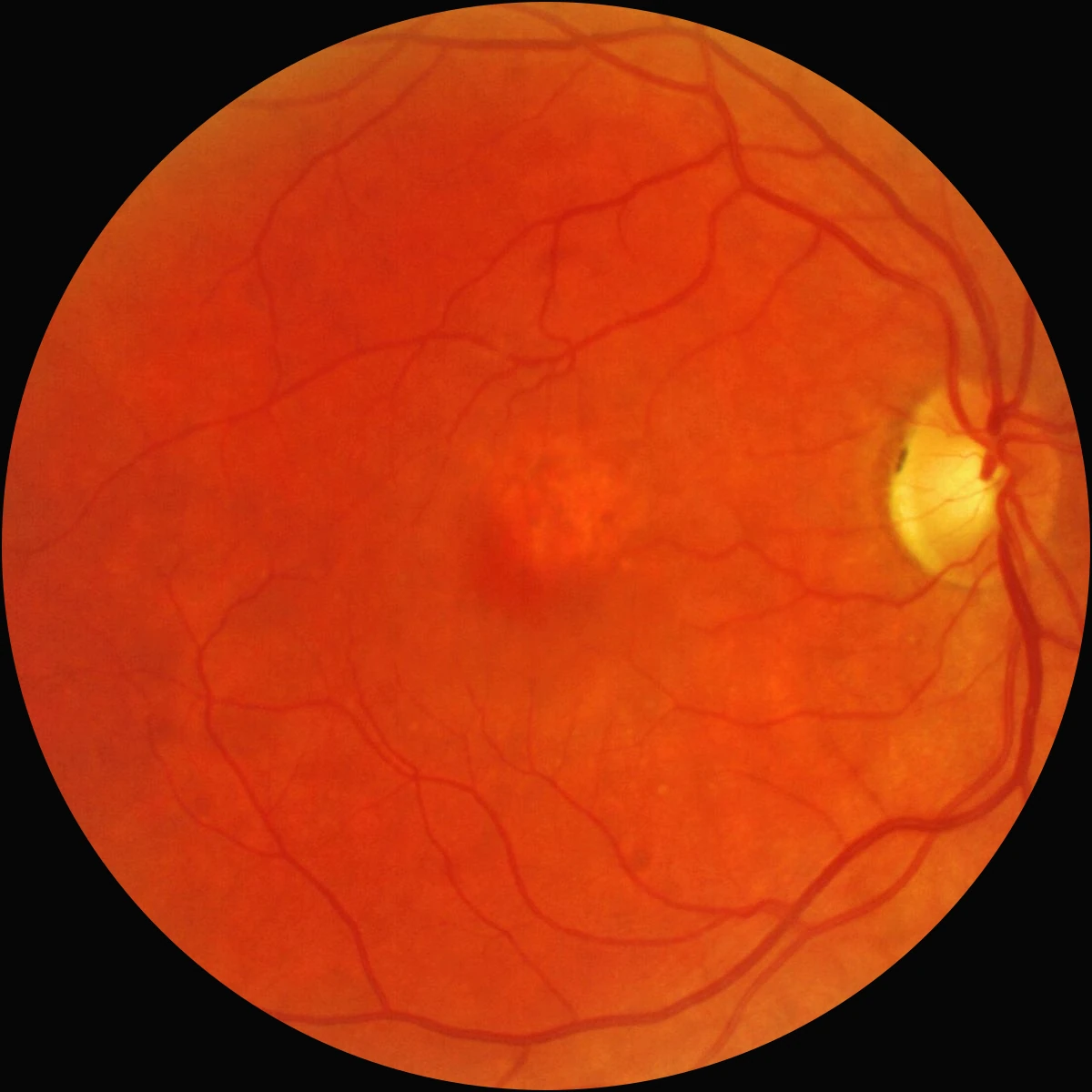 Color fundus photograph of a right eye