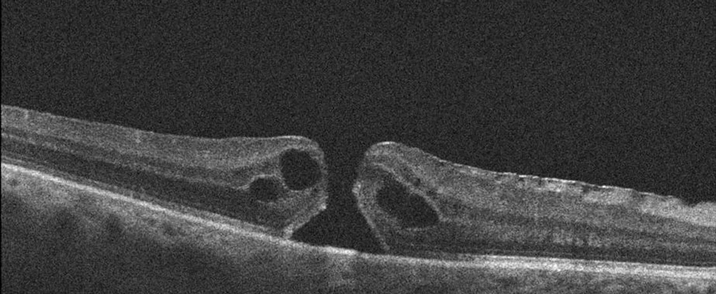 OCT B-scan showing a full-thickness macular hole